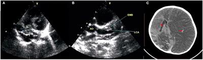 Kawasaki Disease Complicated by Late-Onset Fatal Cerebral Infarction: A Case Report and Literature Review